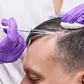 PRF Hair Restoration